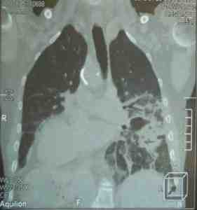 situs-inversus-corte-coronal