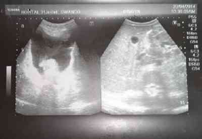 tuberculosis-ecografia-abdominal