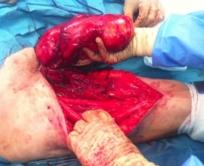 tumor-muslo-cirugia