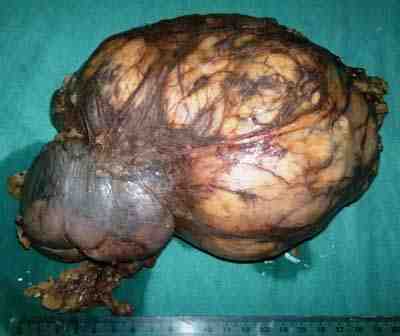 tumor-renal