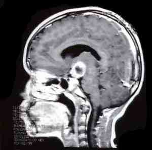 RMN-silla-turca-craneofaringioma