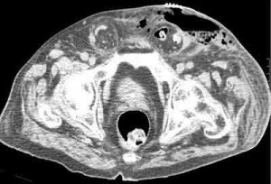 TAC-enfisema-subcutaneo-pelvico