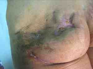 absceso-gluteo-biopolimeros