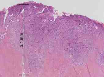 Revision Bibliografica Diagnostico Y Prevencion Del Cancer De Cervix Pagina 4 De 6 Revista Electronica De Portales Medicos Com