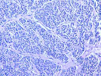 carcinoma-insular-tiroides-tincion