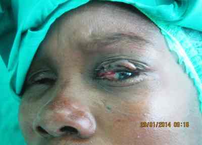 cirugia-tracoma-triquiasis