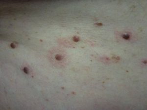 dermatitis-inflamatoria