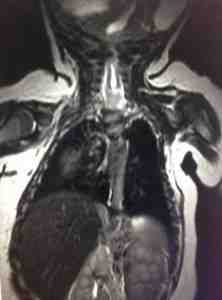dilatacion-siringomielica-medula-espinal