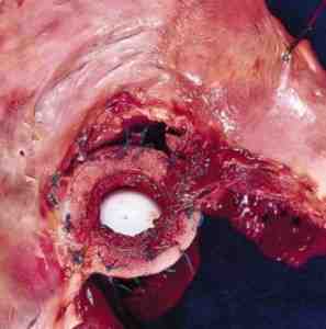 endocarditis-etiologia-causas