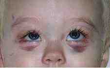 equimosis-hematoma-post-parto