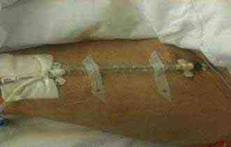 insercion-femoral-balon-contrapulsacion