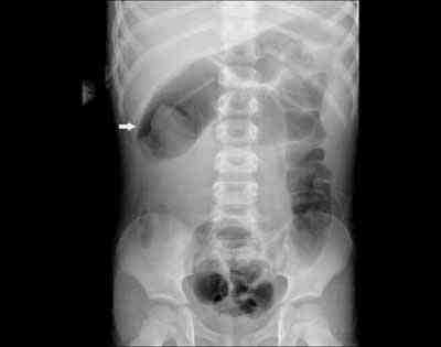invaginacion-intestinal-radiografia-abdomen