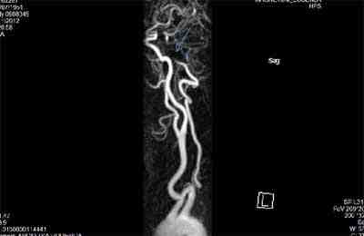 malformacion-AV-congenita-cerebral