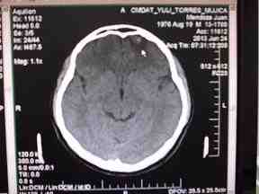 neurocisticercosis-fase-vesicular-coloidal