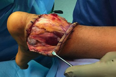 Foto 3. Imagen intraoperatoria de la resección. Se pude apreciar el nervio sural y en la zona medial los vasos y nervio del tibial posterior.