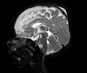 Foto 3: Resonancia Magnética cerebral, corte sagital.