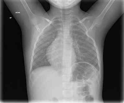 síndrome-de-Poland-radiografia-torax
