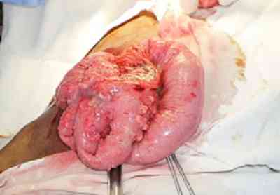 tuberculosis-miliar-intestinal