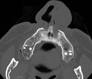 carcinoma-sebaceo-tac