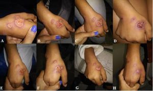 Leishmaniasis-cutanea-evolucion-lesiones