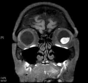 melanoma-coroideo-corte-coronal