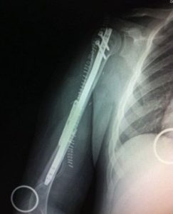 radiografia-humero-aloinjerto-tras-tumor
