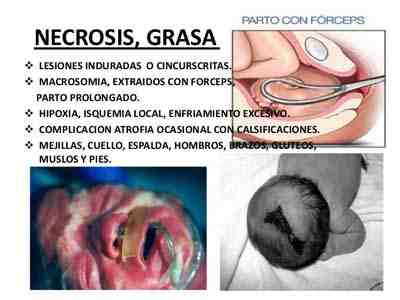 recien-nacido-necrosis-grasa