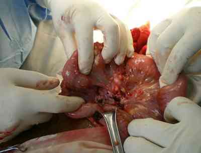 tuberculosis-ileitis-terminal