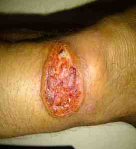 ulcera-torpida-leishmaniasis-cutanea