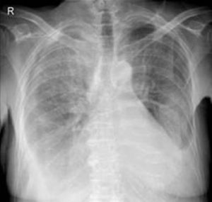 Rx-torax-insuficiencia-cardiaca