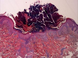 epidermis-tejido-inflamatorio-necrotico