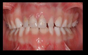 5-osteogenesis-imperfecta