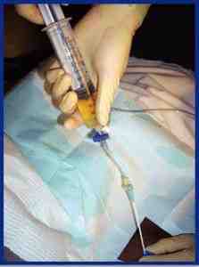 tecnica-puncion-abdominal