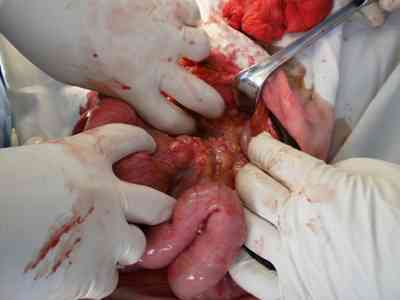 tuberculosis-intestinal-cirugia