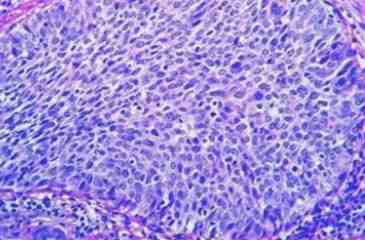 cancer-cervix-lesiones-preinvasivas-celulas-pequeñas