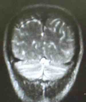 torcula-RMN-coronal