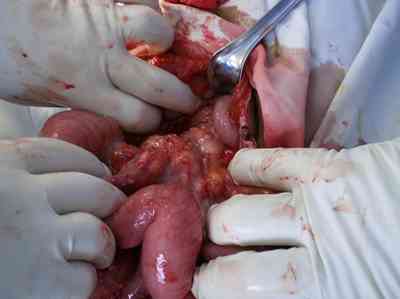 tuberculosis-abdominal-siembra