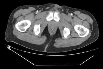 TAC-abdominal-adenocarcinoma-rectal