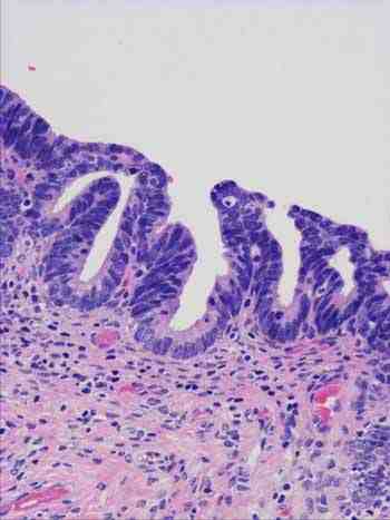 cancer-cervix-adenocarcinoma-in-situ