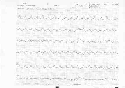ECG 1_1