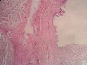 adenocarcinoma-anatomia-patologica