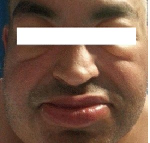 angioedema-secundario-IECA