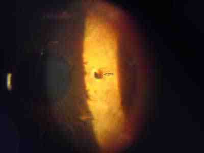 cuerpo-extraño-intraocular