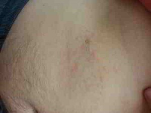 dermatitis-irritativa