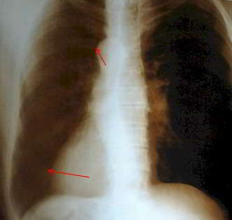 dextrocardia