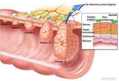 cancer de colon con ganglios afectados)