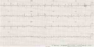 displasia-arritmogenica-ventriculo-derecho