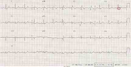 displasia-arritmogenica-ventriculo-derecho