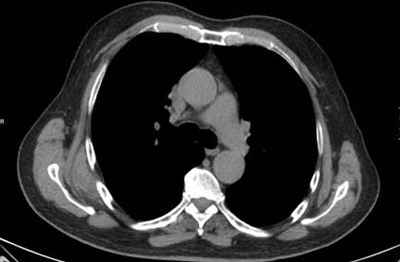 elastofibroma-dorsi-lipoma-dorsal-subescapular