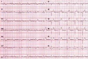 electrocardiograma-EKG